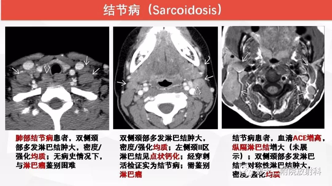影像PPT - 【PPT】颈部淋巴结肿大的鉴别诊断-31