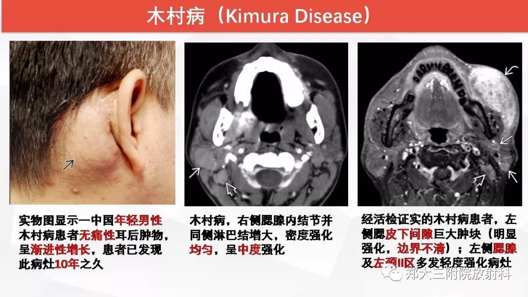 影像PPT - 【PPT】颈部淋巴结肿大的鉴别诊断-35