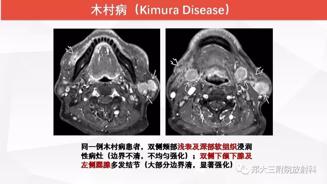 影像PPT - 【PPT】颈部淋巴结肿大的鉴别诊断-36