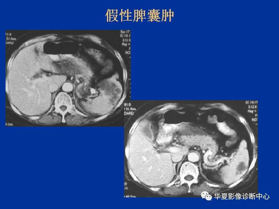 影像PPT - 【PPT】脾脏疾病CT诊断-16