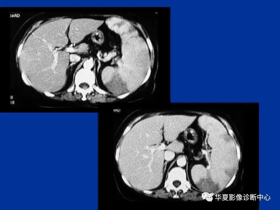 影像PPT - 【PPT】脾脏疾病CT诊断-22