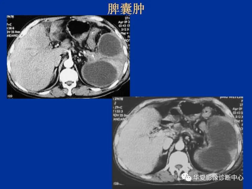 影像PPT - 【PPT】脾脏疾病CT诊断-17
