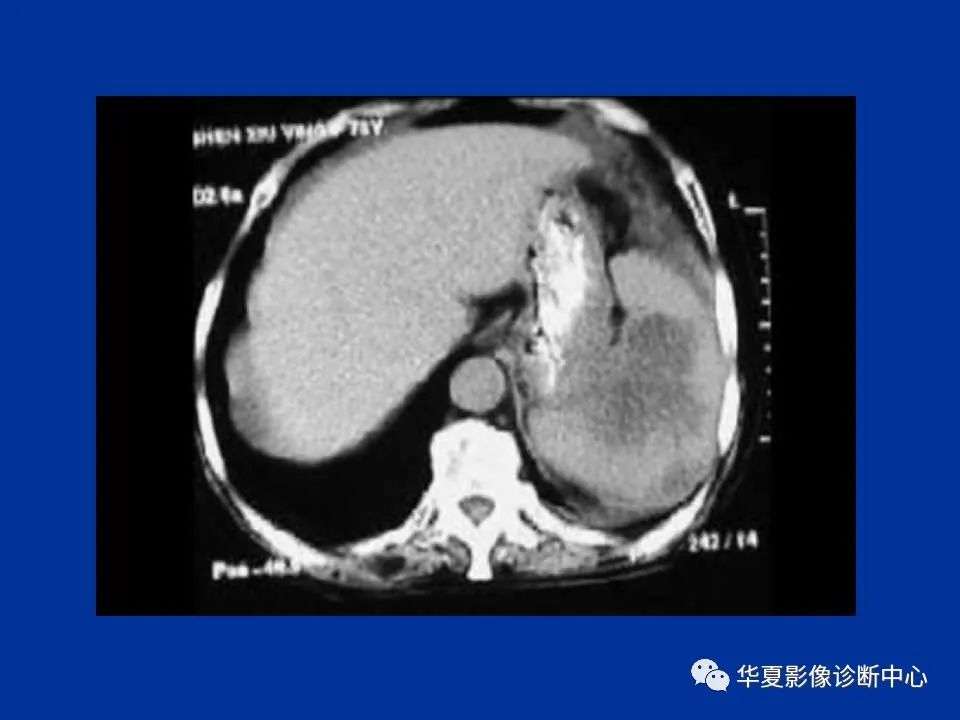 影像PPT - 【PPT】脾脏疾病CT诊断-45