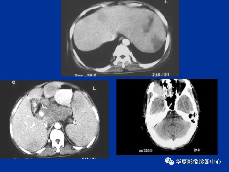 影像PPT - 【PPT】脾脏疾病CT诊断-50