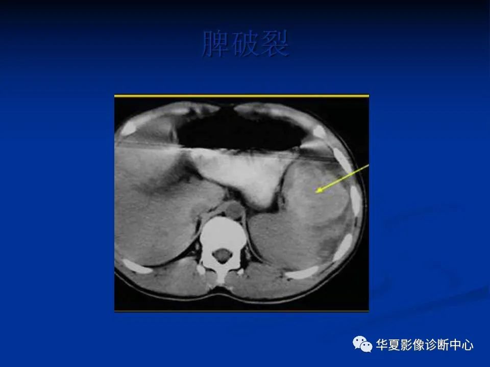 影像PPT - 【PPT】脾脏疾病CT诊断-59