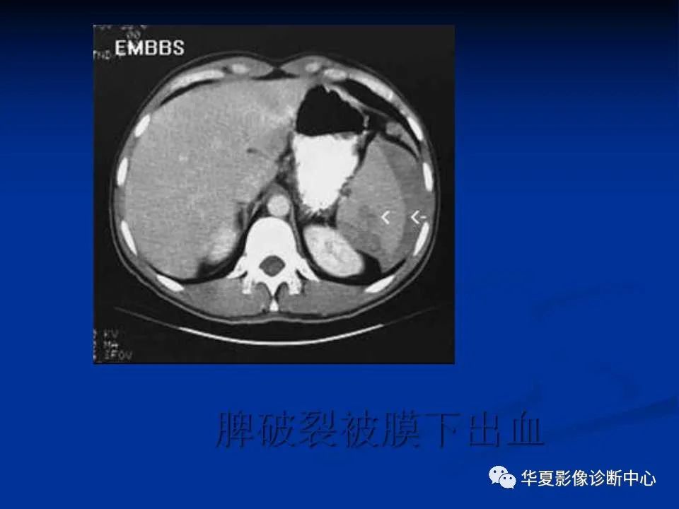 影像PPT - 【PPT】脾脏疾病CT诊断-60