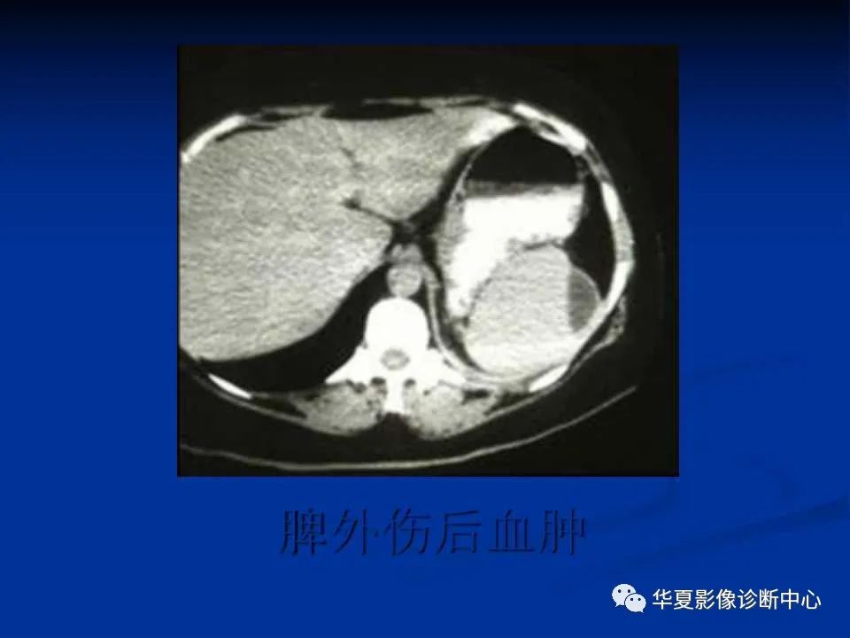 影像PPT - 【PPT】脾脏疾病CT诊断-62