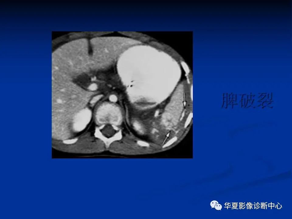 影像PPT - 【PPT】脾脏疾病CT诊断-63