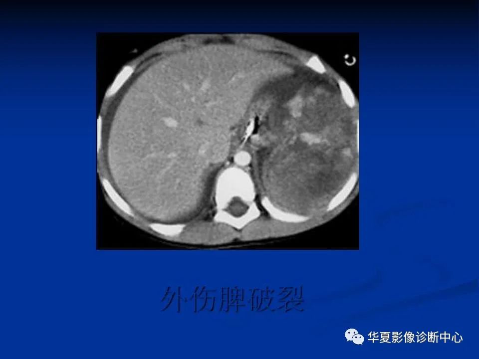 影像PPT - 【PPT】脾脏疾病CT诊断-61