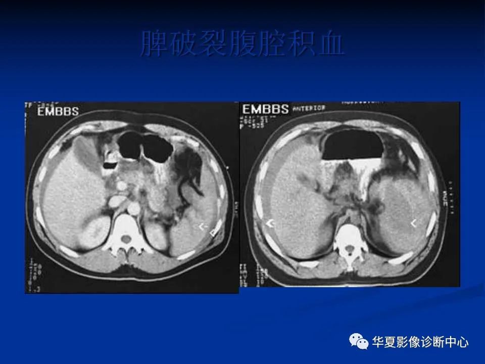 影像PPT - 【PPT】脾脏疾病CT诊断-64