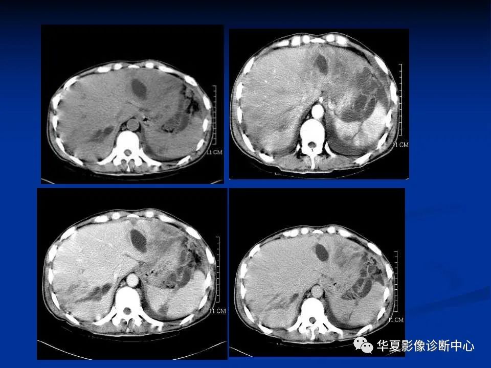 影像PPT - 【PPT】脾脏疾病CT诊断-65