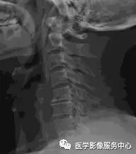 影像PPT - 平片诊断颈椎病的五大标准-3 影像PPT - 平片诊断颈椎病的五大标准-3