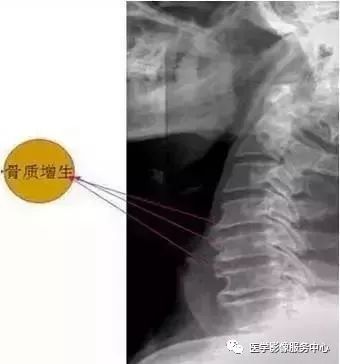 影像PPT - 平片诊断颈椎病的五大标准-2 影像PPT - 平片诊断颈椎病的五大标准-2