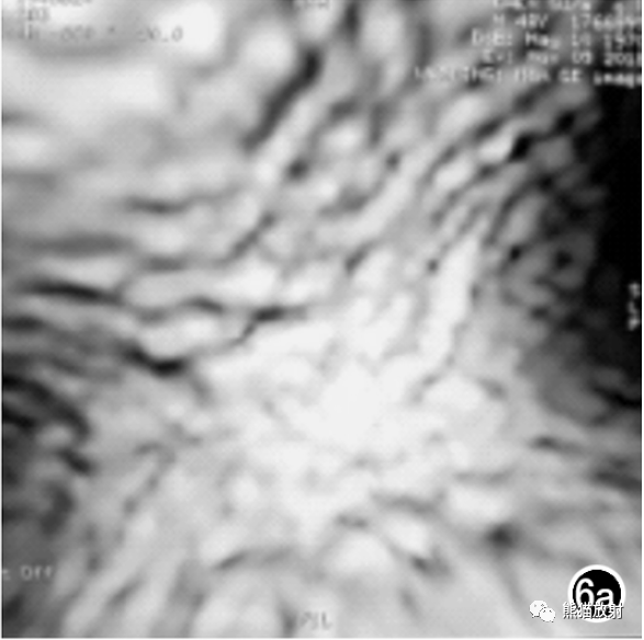 影像PPT - 气管憩室的CT表现、随访其变化的意义-6 影像PPT - 气管憩室的CT表现、随访其变化的意义-6