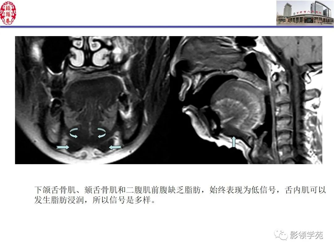 影像PPT - 【PPT】舌、口底影像解剖及常见疾病诊断-19