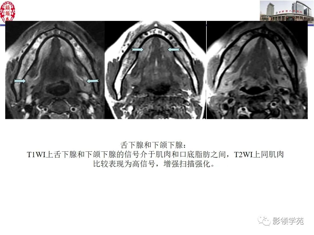 影像PPT - 【PPT】舌、口底影像解剖及常见疾病诊断-20