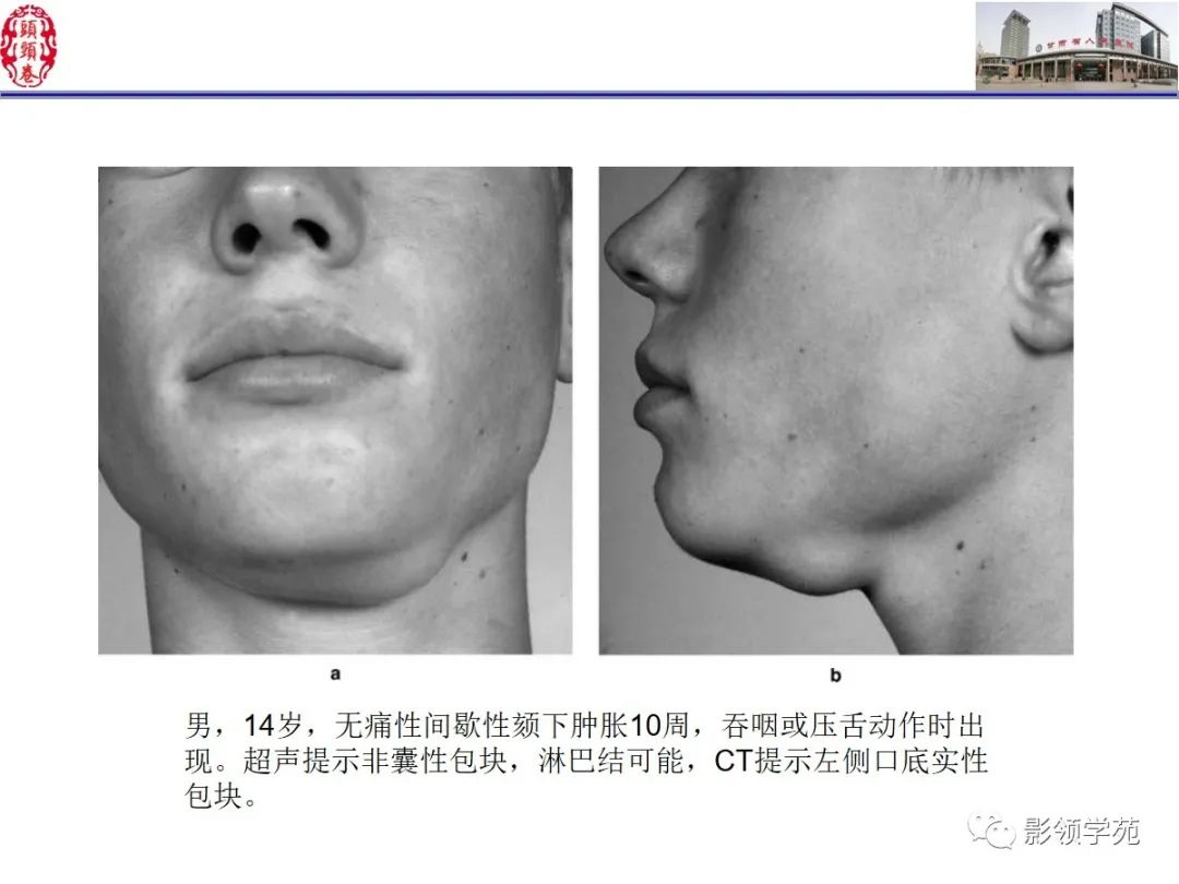 影像PPT - 【PPT】舌、口底影像解剖及常见疾病诊断-23
