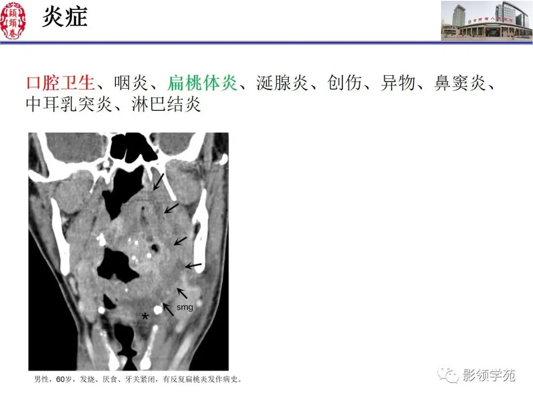 影像PPT - 【PPT】舌、口底影像解剖及常见疾病诊断-28