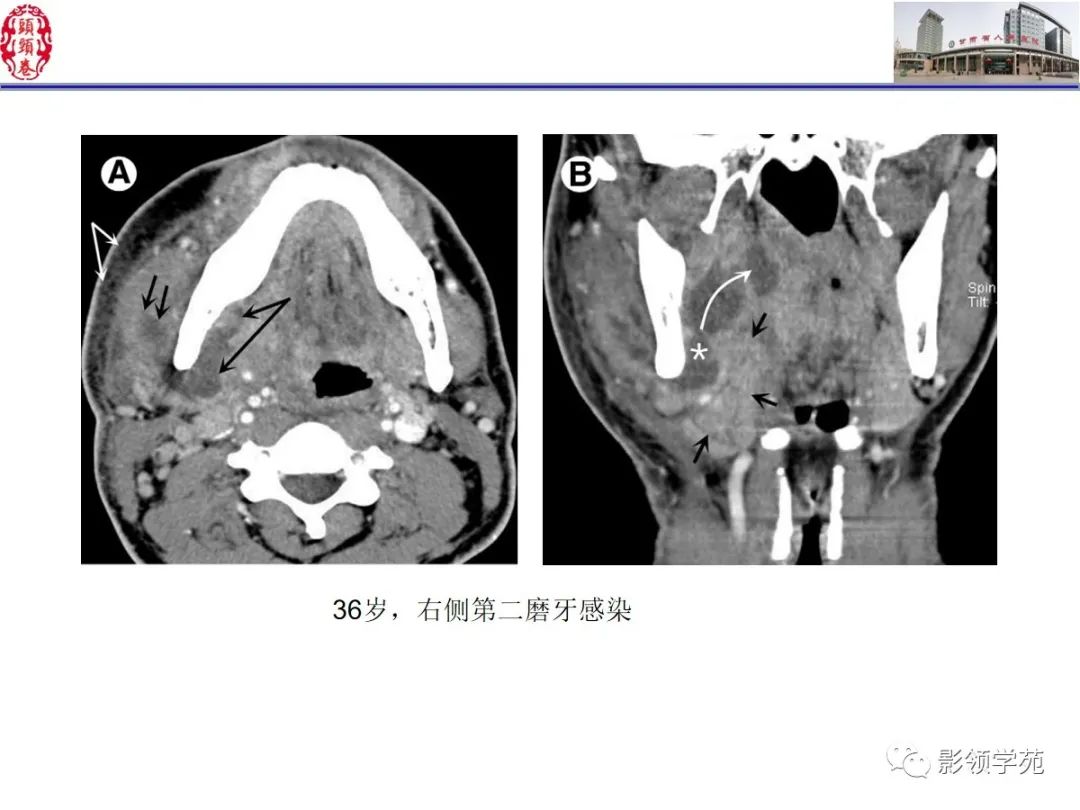 影像PPT - 【PPT】舌、口底影像解剖及常见疾病诊断-29
