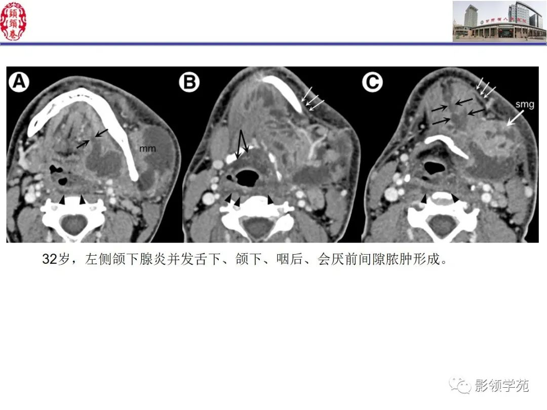 影像PPT - 【PPT】舌、口底影像解剖及常见疾病诊断-31
