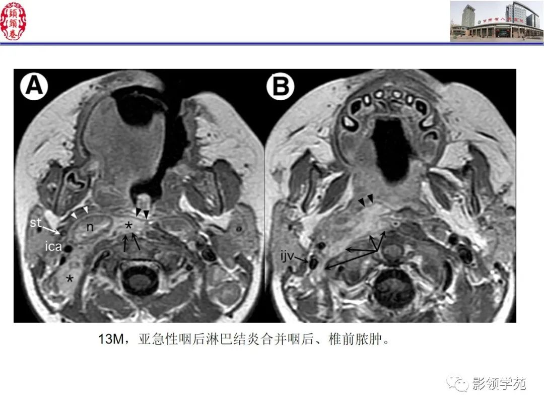 影像PPT - 【PPT】舌、口底影像解剖及常见疾病诊断-33