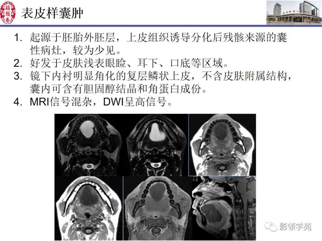 影像PPT - 【PPT】舌、口底影像解剖及常见疾病诊断-41
