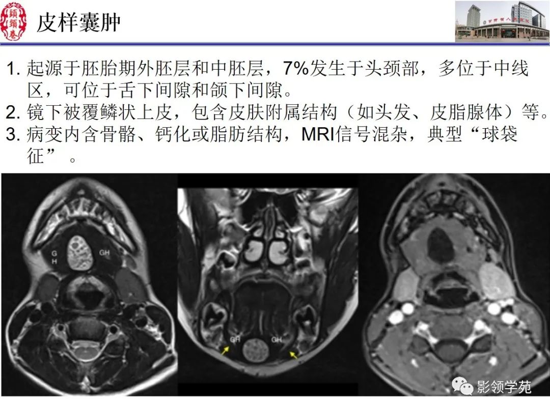影像PPT - 【PPT】舌、口底影像解剖及常见疾病诊断-39
