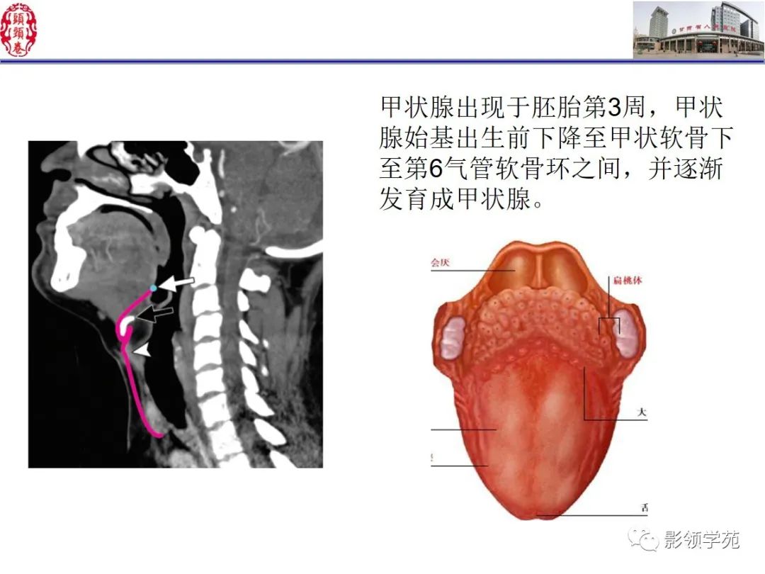 影像PPT - 【PPT】舌、口底影像解剖及常见疾病诊断-42