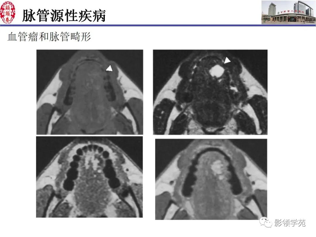 影像PPT - 【PPT】舌、口底影像解剖及常见疾病诊断-50