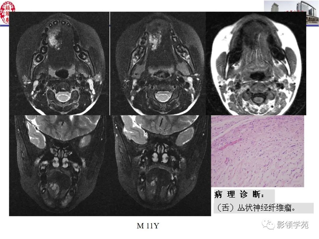 影像PPT - 【PPT】舌、口底影像解剖及常见疾病诊断-55