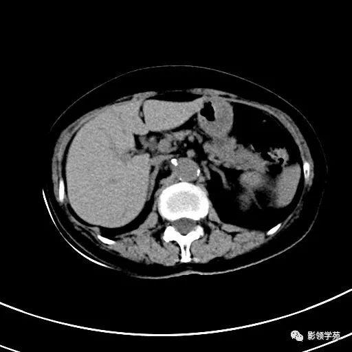 影像PPT - 【病例】浆液性囊腺瘤1例CT影像-1 影像PPT - 【病例】浆液性囊腺瘤1例CT影像-1