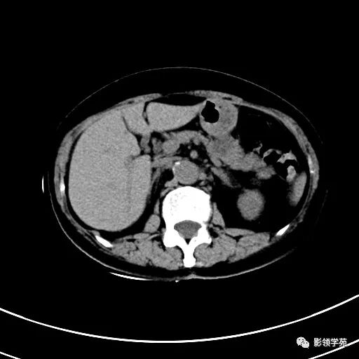影像PPT - 【病例】浆液性囊腺瘤1例CT影像-2 影像PPT - 【病例】浆液性囊腺瘤1例CT影像-2