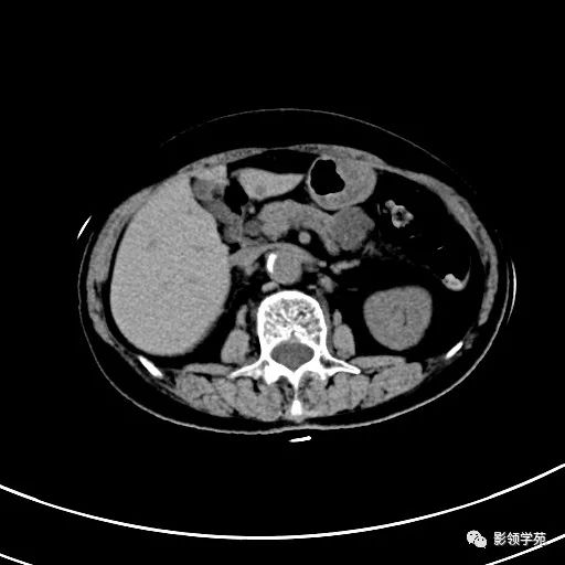 影像PPT - 【病例】浆液性囊腺瘤1例CT影像-4 影像PPT - 【病例】浆液性囊腺瘤1例CT影像-4
