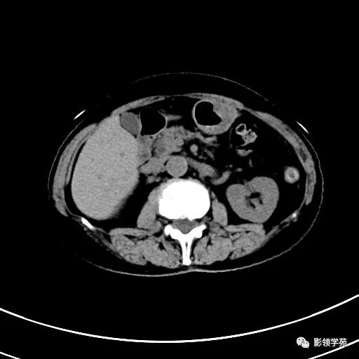 影像PPT - 【病例】浆液性囊腺瘤1例CT影像-6 影像PPT - 【病例】浆液性囊腺瘤1例CT影像-6