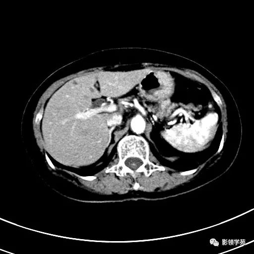 影像PPT - 【病例】浆液性囊腺瘤1例CT影像-7 影像PPT - 【病例】浆液性囊腺瘤1例CT影像-7