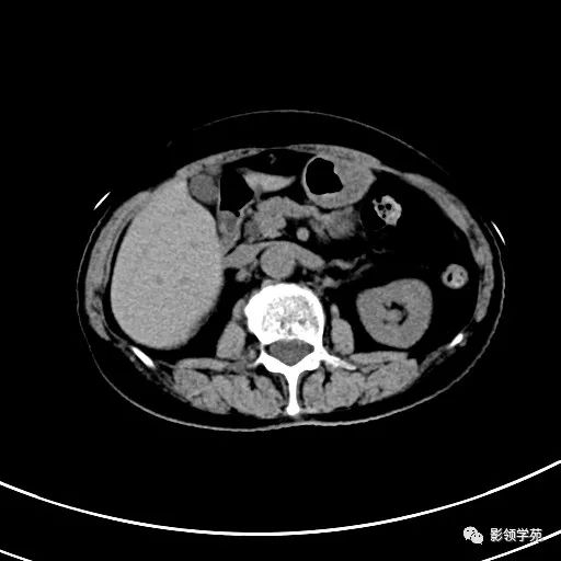 影像PPT - 【病例】浆液性囊腺瘤1例CT影像-5 影像PPT - 【病例】浆液性囊腺瘤1例CT影像-5