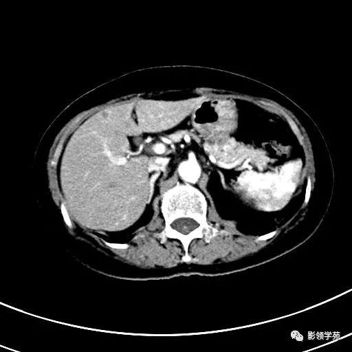 影像PPT - 【病例】浆液性囊腺瘤1例CT影像-8 影像PPT - 【病例】浆液性囊腺瘤1例CT影像-8