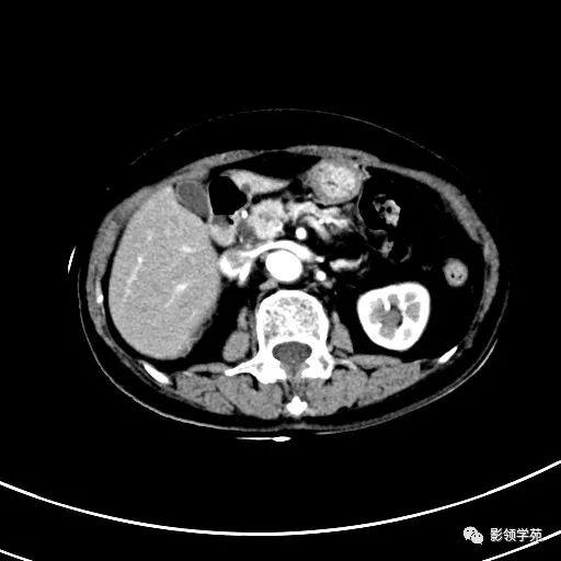 影像PPT - 【病例】浆液性囊腺瘤1例CT影像-12 影像PPT - 【病例】浆液性囊腺瘤1例CT影像-12