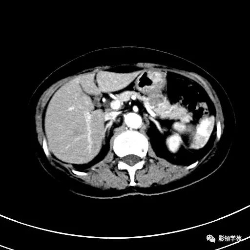 影像PPT - 【病例】浆液性囊腺瘤1例CT影像-9 影像PPT - 【病例】浆液性囊腺瘤1例CT影像-9