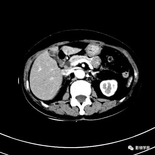 影像PPT - 【病例】浆液性囊腺瘤1例CT影像-11 影像PPT - 【病例】浆液性囊腺瘤1例CT影像-11