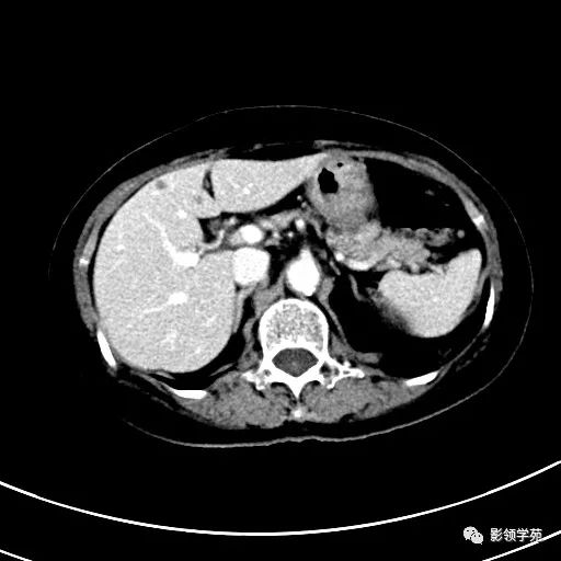 影像PPT - 【病例】浆液性囊腺瘤1例CT影像-13 影像PPT - 【病例】浆液性囊腺瘤1例CT影像-13