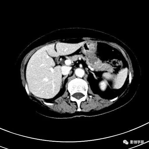 影像PPT - 【病例】浆液性囊腺瘤1例CT影像-14 影像PPT - 【病例】浆液性囊腺瘤1例CT影像-14