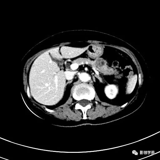 影像PPT - 【病例】浆液性囊腺瘤1例CT影像-15 影像PPT - 【病例】浆液性囊腺瘤1例CT影像-15