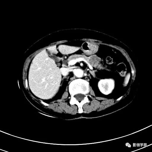 影像PPT - 【病例】浆液性囊腺瘤1例CT影像-16 影像PPT - 【病例】浆液性囊腺瘤1例CT影像-16