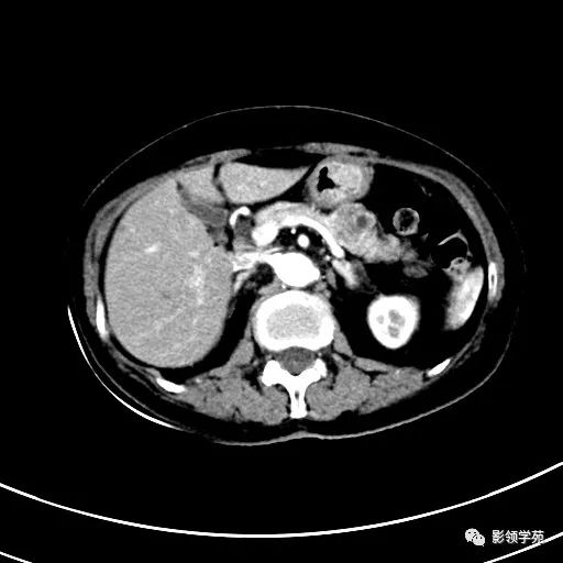 影像PPT - 【病例】浆液性囊腺瘤1例CT影像-10 影像PPT - 【病例】浆液性囊腺瘤1例CT影像-10