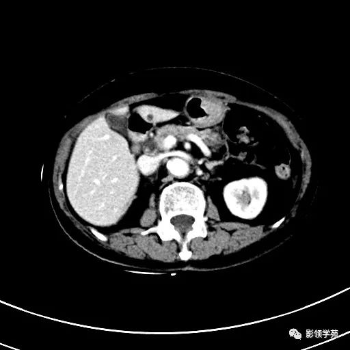 影像PPT - 【病例】浆液性囊腺瘤1例CT影像-17 影像PPT - 【病例】浆液性囊腺瘤1例CT影像-17