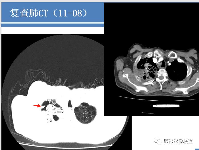 影像PPT - 【病例】结核千千面-42 影像PPT - 【病例】结核千千面-42