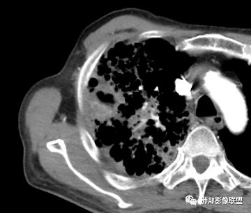 影像PPT - 【病例】结核千千面-43 影像PPT - 【病例】结核千千面-43