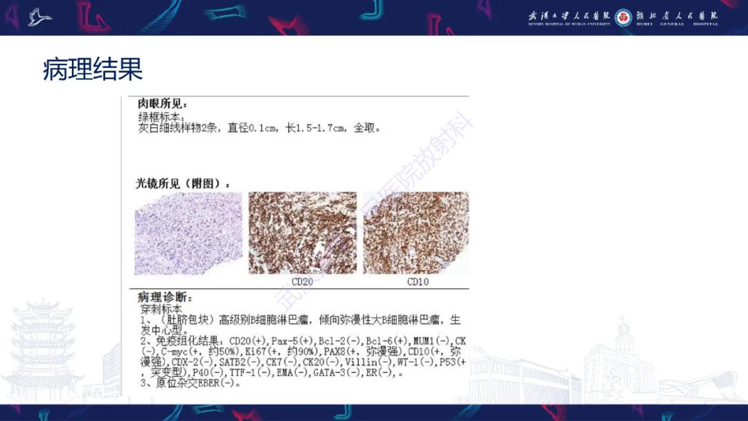 影像PPT - 【PPT】原发性大肠淋巴瘤影像诊断-5