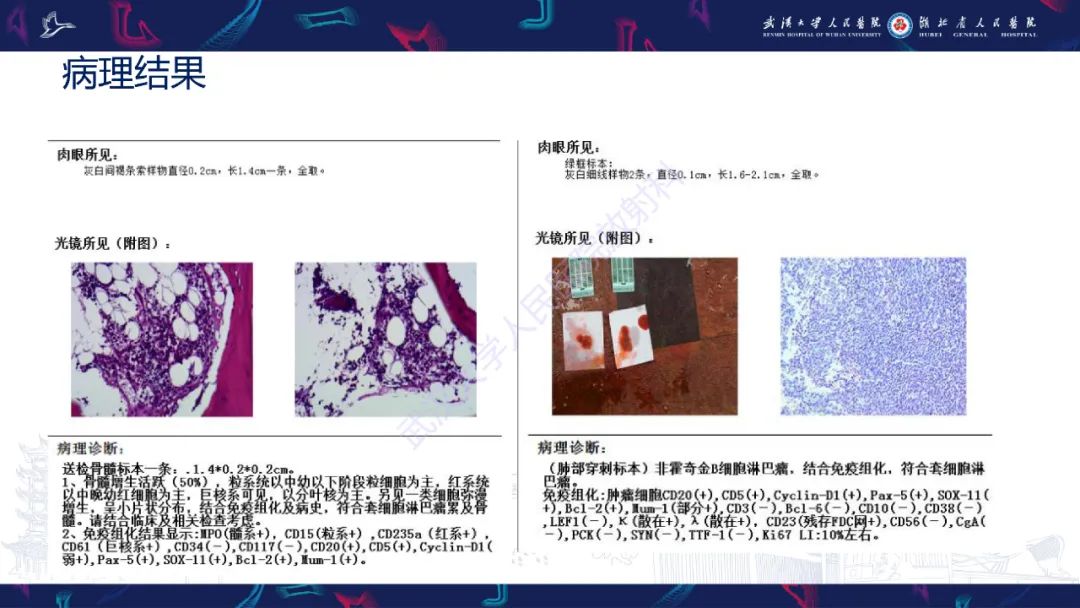 影像PPT - 【PPT】原发性大肠淋巴瘤影像诊断-6